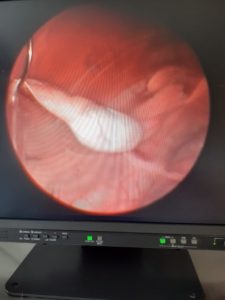 Opname tijdens laparoscopische operatie